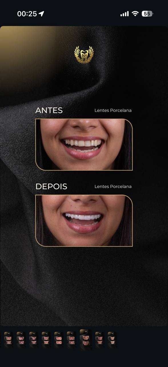 Antes e depois de lentes em porcelana