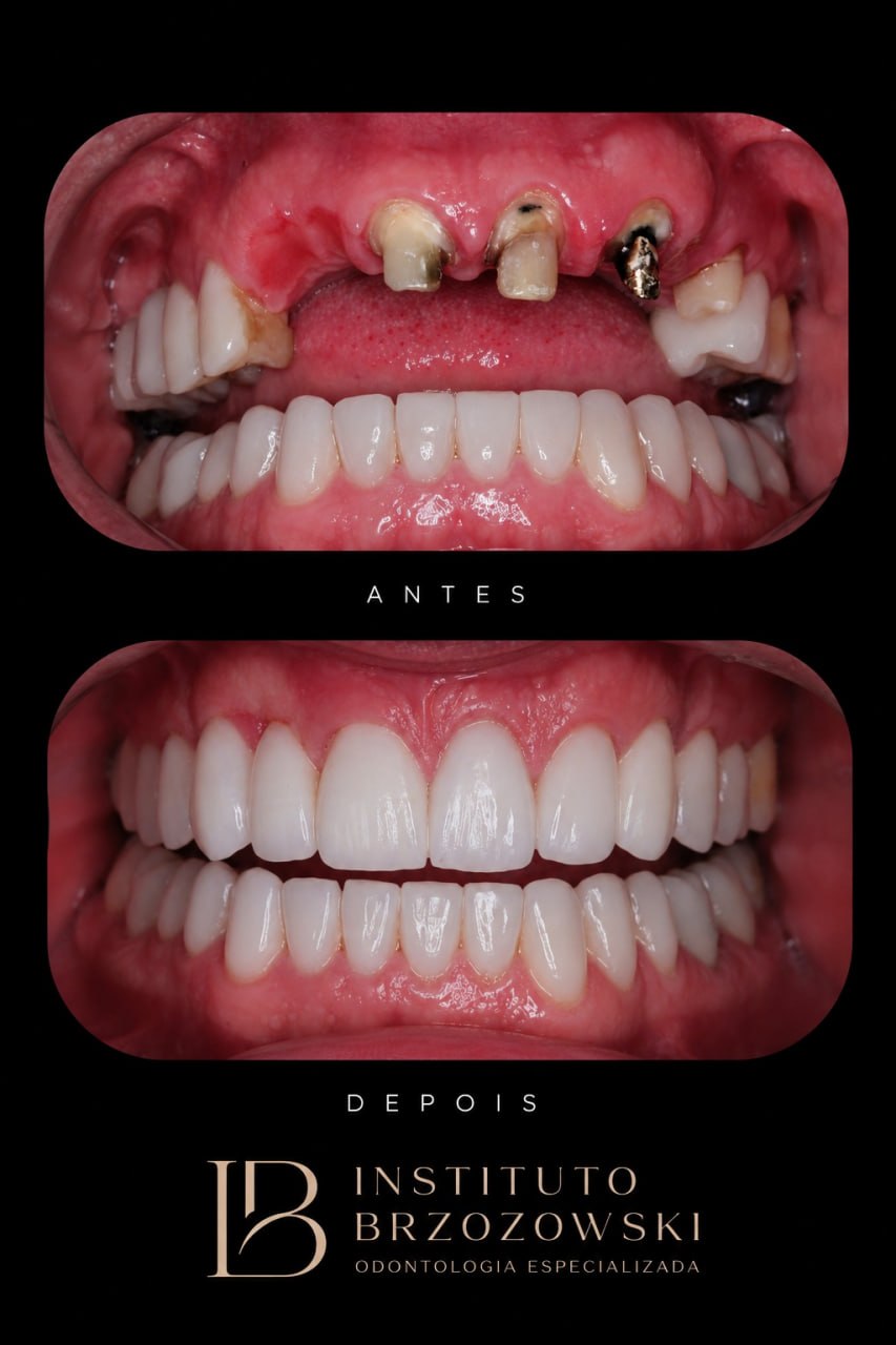 Antes e depois de reabilitacao oral realizada no Instituto Brzozowski