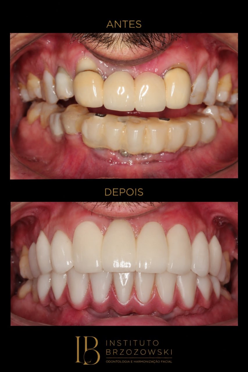 Antes e depois de caso odontologico realizado no Instituto Brzozowski