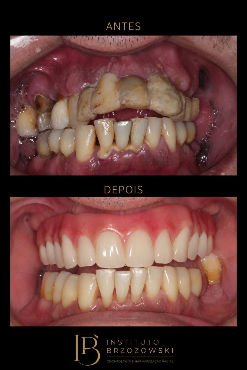 Antes e depois de tratamento odontologico realizado no Instituto Brzozowski